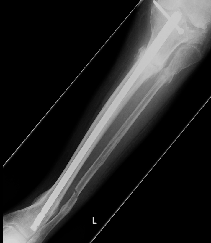 Tibial Malunion AP